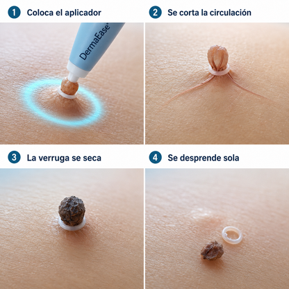 Kit de Eliminación de Verrugas — Sin Dolor