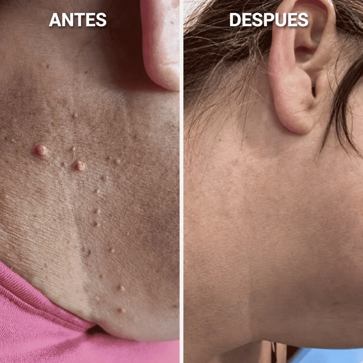 Kit de Eliminación de Verrugas — Sin Dolor